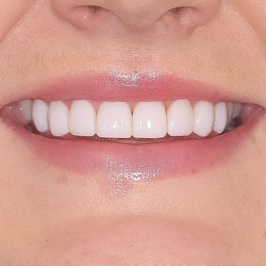 clip on veneers - after - smile 4 - 3Dental